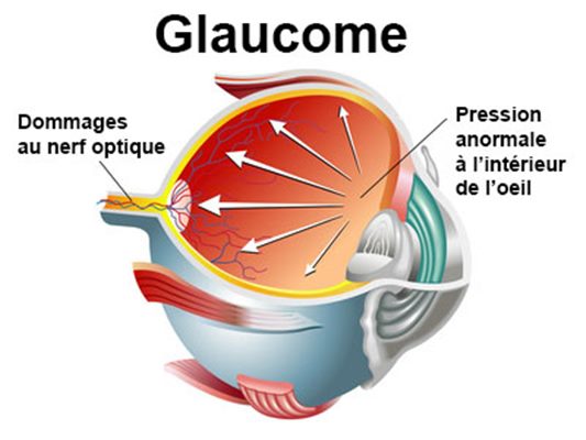 glaucome-nerf-optique