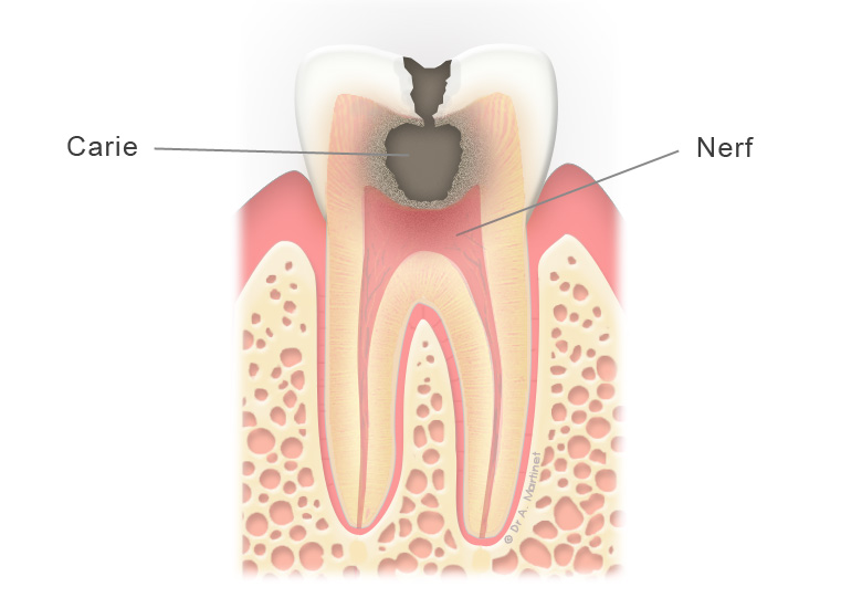 carie-dents-devitalisation
