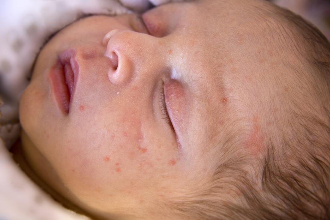 acne-bebe-neonatal