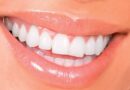 Les facettes peuvent-elles endommager vos vraies dents ?